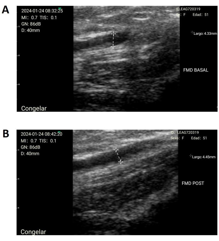 Ultrasound images comparing vascular measurements pre and post dilation.