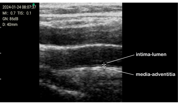 Arterial wall analysis via ultrasound image; labeled intima-lumen and media-adventitia layers.