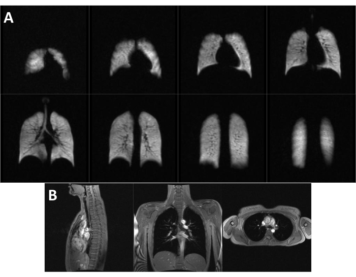 Pulmonary MRI scans; diagrams show lung imaging processes and anatomical structures for diagnostic use.
