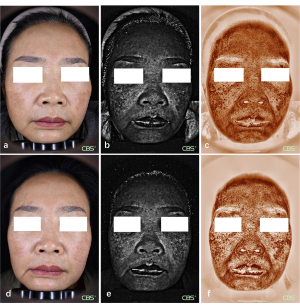 figure-results-2 Facial analysis images; skin texture and pigmentation study using multispectral imaging.
