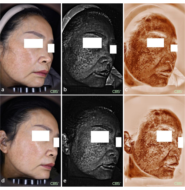 figure-results-3 Facial skin analysis using multispectral imaging; compares pigmentation changes pre-and post-treatment.
