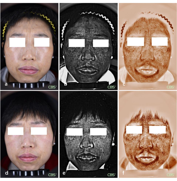 figure-results-5 Facial skin analysis using imaging technique; color, UV, and thermal effects; dermatological study.
