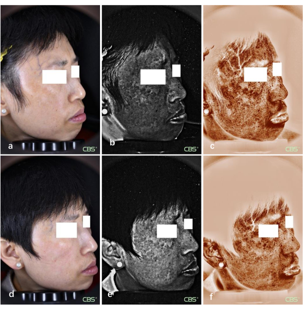 figure-results-6 Facial skin analysis via multispectral imaging; diagram of surface and subsurface pigmentation.