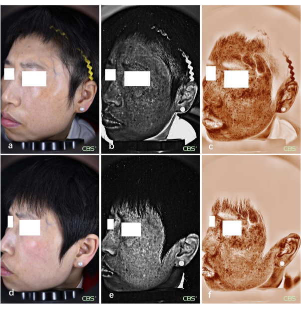 figure-results-7 Facial skin analysis showing UV imaging results and pigmentation distribution in a comparison study.