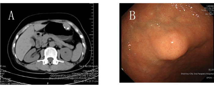 CT scan and endoscopy image; medical diagnostic comparison of abdominal region.