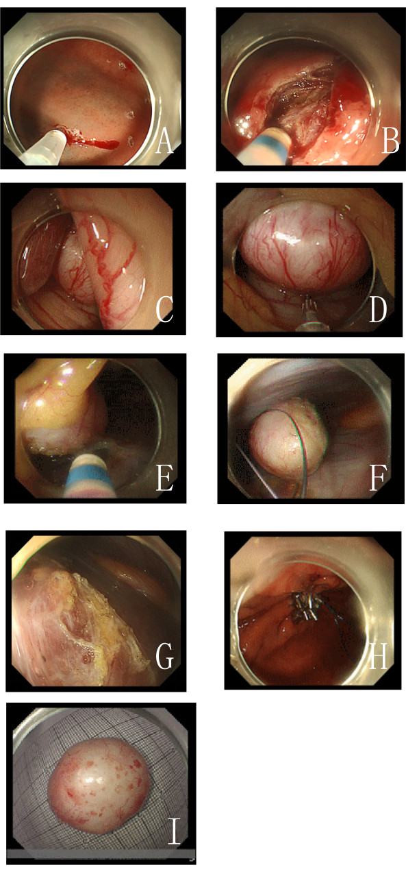 Endoscopic surgery sequence: tumor excision and closure, steps A-I.