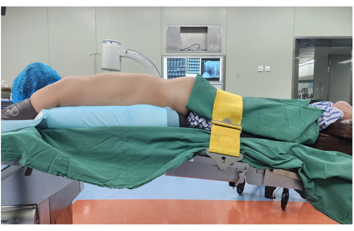 figure-results-1 Surgical positioning setup for spinal procedure, featuring patient secured on operating table.