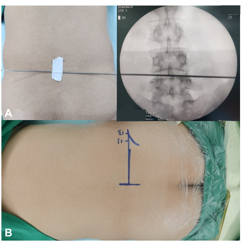 figure-results-2 Lumbar puncture needle position, spinal x-ray image and marked anatomical reference, procedural guide.