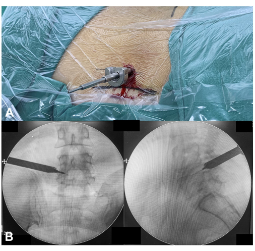 figure-results-4 Minimally invasive spinal surgery setup; fluoroscopy images showing spinal alignment and instrument placement.