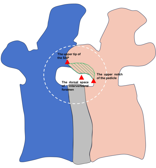 figure-results-6 Vertebral anatomy diagram; SAP, pedicle, intervertebral foramen labeled for educational insight.