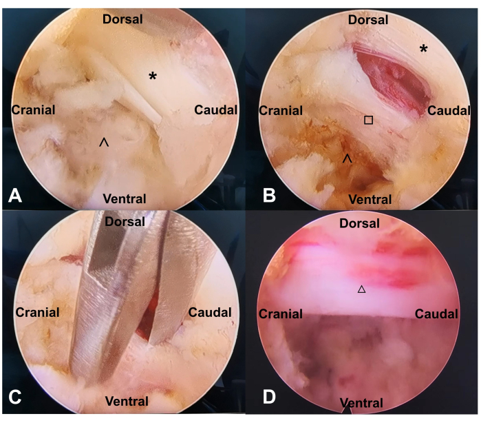 figure-results-8 Arthroscopic shoulder procedure process, labeled regions, anatomy clarification, surgical imagery.
