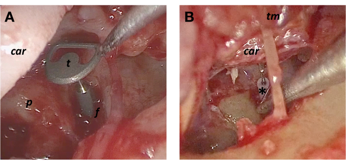 Surgical procedure illustrating anatomical structures with labeled parts, focusing on medical techniques.