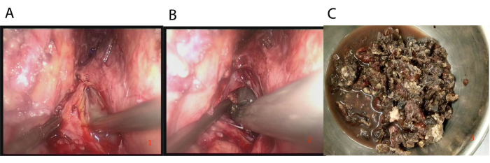 Surgical removal process sequence; steps A and B: tissue extraction; C: excised tissue result.