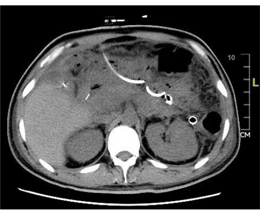 CT scan cross-sectional image, abdomen analysis, medical imaging, diagnostic radiology equipment.