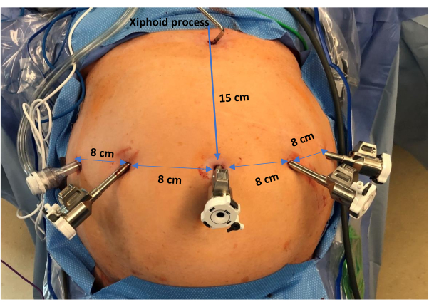 figure-results-2 Laparoscopic surgery setup diagram, showing port placement around abdomen for minimally invasive access.
