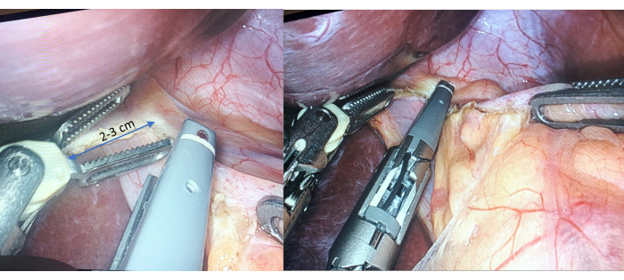 figure-results-3 Laparoscopic surgery procedure showing tissue dissection and stapling instrument detail.