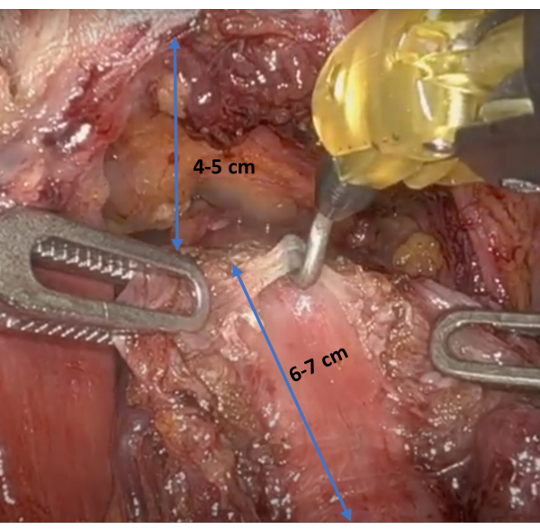 figure-results-4 Surgical procedure diagram showing tissue measurement; tools indicating 4-7 cm incisions.