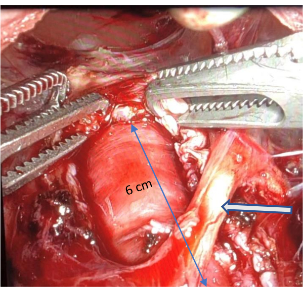 figure-results-5 Surgical anatomy dissection; branch identification; close-up; educational diagram; procedure visualization.