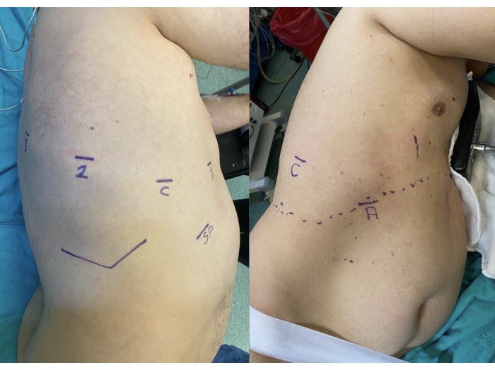figure-results-1 Surgical marking diagram on torso for medical procedure planning, showing incision lines and labels.