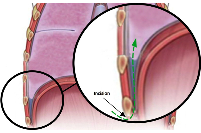 figure-results-2 Sagittal incision diagram in arterial dissection procedure illustrating surgical pathway.