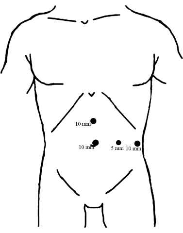 figure-results-1 Laparoscopic surgery incision diagram on abdomen; trocar entry points marked with sizes (5mm, 10mm).