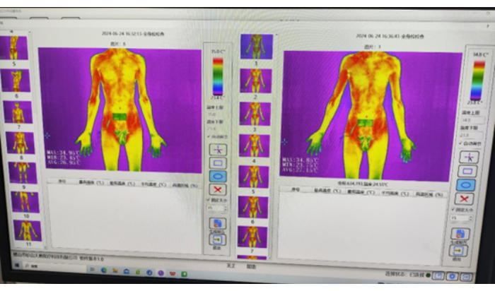 Thermal imaging analysis, body temperature distribution, infrared images for medical diagnostics.