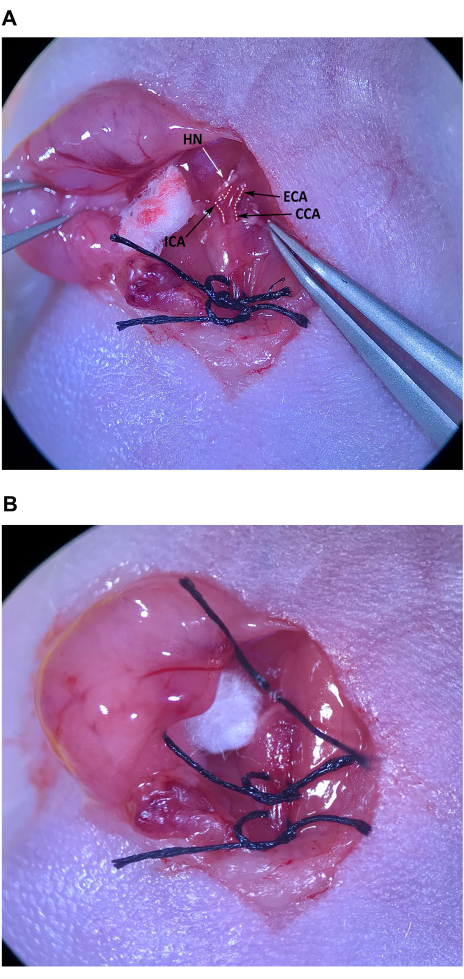 Surgical anatomy with labeled carotid arteries; procedure demonstration, macro photography.