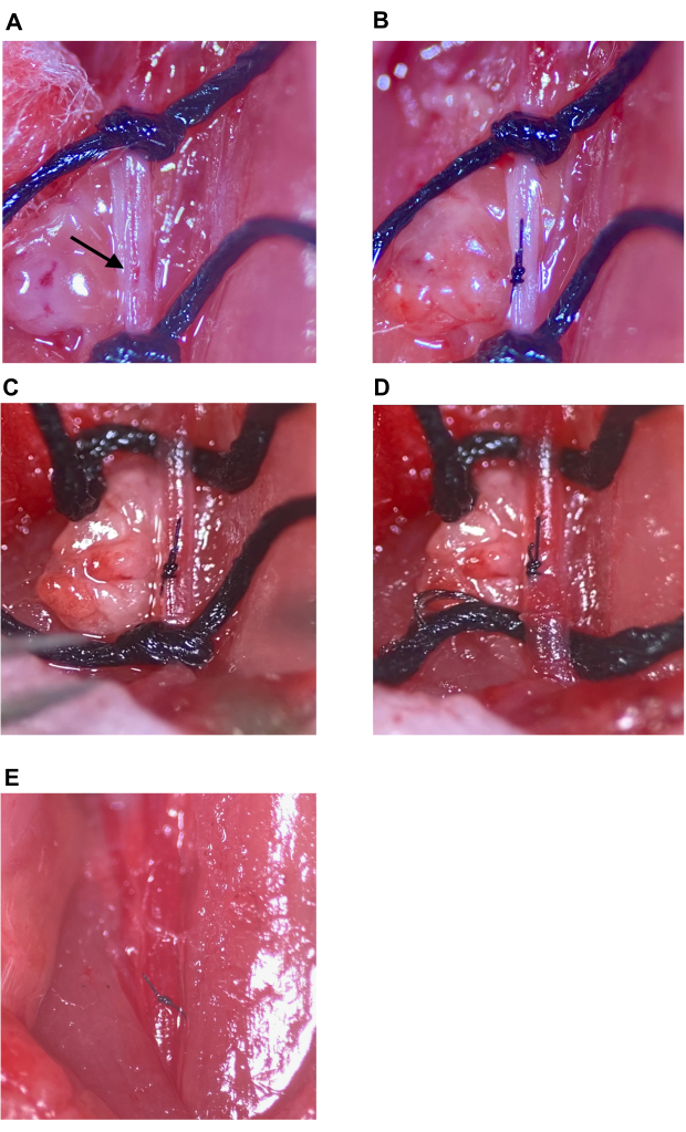 Surgical technique sequence, arterial suturing close-up, intraoperative procedure images, vascular repair.