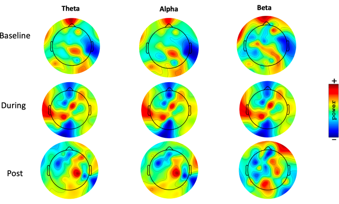EEG power spectrum maps; Theta, Alpha, Beta bands; baseline, during, and post event analysis.