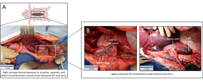 figure-results-2 Surgical diagram illustrating retroperitoneal exposure for infra-renal IVC and aorta control.