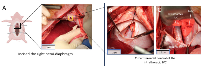 figure-results-3 Surgical procedure on diaphragm and intrathoracic IVC; incision and circumferential control steps.