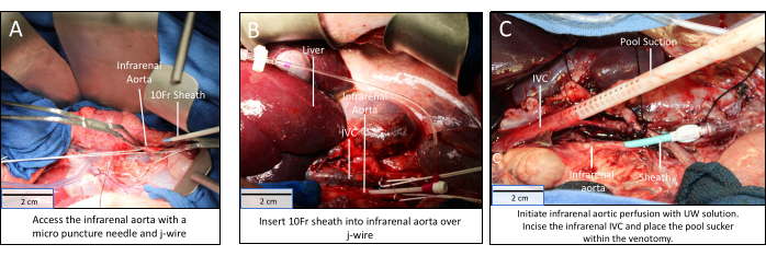 figure-results-4 Infrarenal aorta surgery process, 10Fr sheath insertion, diagram, vascular intervention steps.