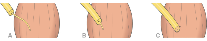 Catheter insertion sequence diagram: steps A to C, demonstrating proper technique for insertion.