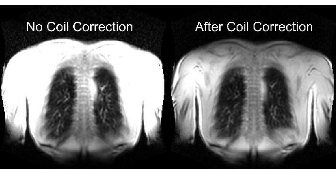 MRI image comparison of coil correction process in thoracic imaging; before and after enhancement.