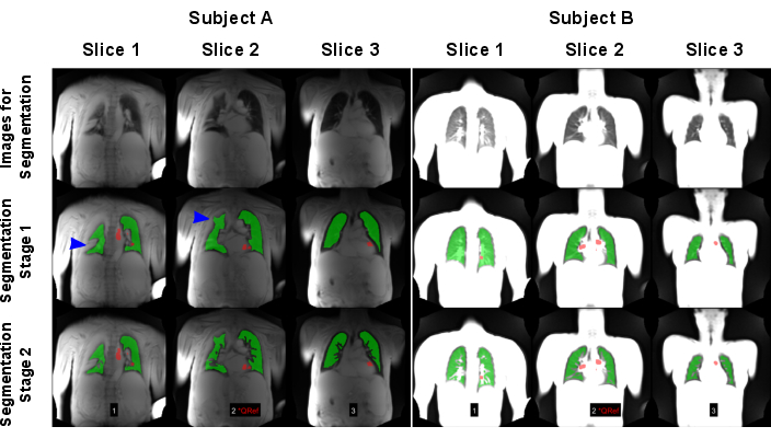 Lung segmentation, MRI analysis, comparison diagram, segmentation stages, image slices, Subjects A and B.