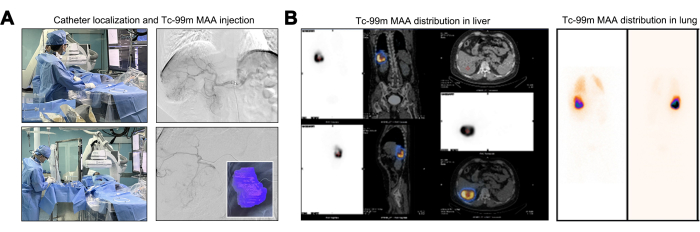 Catheter localization for Tc-99m MAA injection; liver and lung distribution observed in scan results.