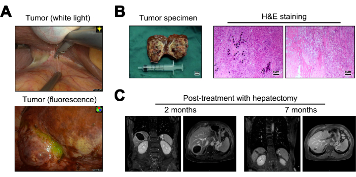 Tumor detection in white light and fluorescence, histology, MRI pre/post-hepatectomy results.