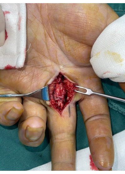 Hand surgery open wound procedure; surgical tools; medical operation; tissue and anatomy detail.
