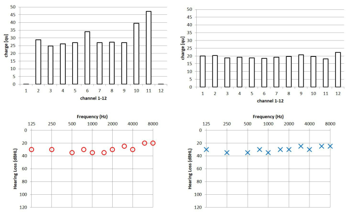 Bar and line graphs showing charge distribution and hearing loss analysis by frequency channels.