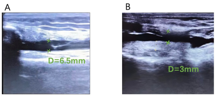 figure-results-4 超声对比;D=6.5mm,D=3mm;诊断成像;医学测量分析。