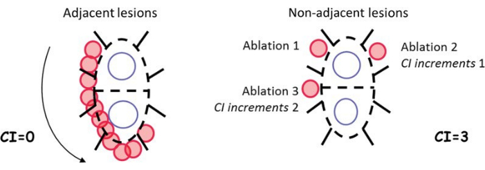 figure-introduction-1 Static equilibrium concept, diagram of lesion ablation process, CI increment comparison.