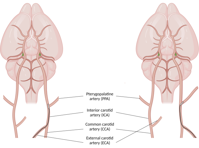 Diagram of arterial structures in the brain, showing PPA, ICA, CCA, and ECA pathways.