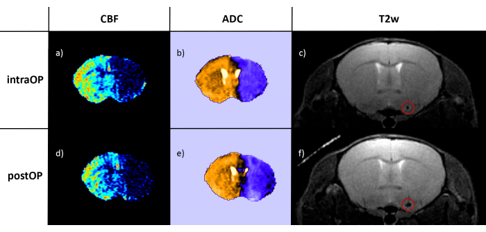 Brain imaging comparison: CBF, ADC, T2w maps; intra/post-op; MRI data analysis, surgical impact.