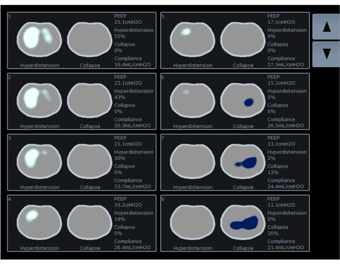figure-results-2 مخطط امتثال الرئة ؛ مستويات PEEP, فرط الانتفاخ, الاختلافات الانهيار; تحليل الأشعة المقطعية.