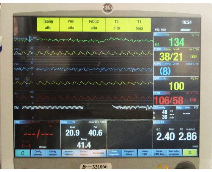 Thermodilution Sensor Determination of Cardiac Output in a Porcine Model for Ex Vivo ...
