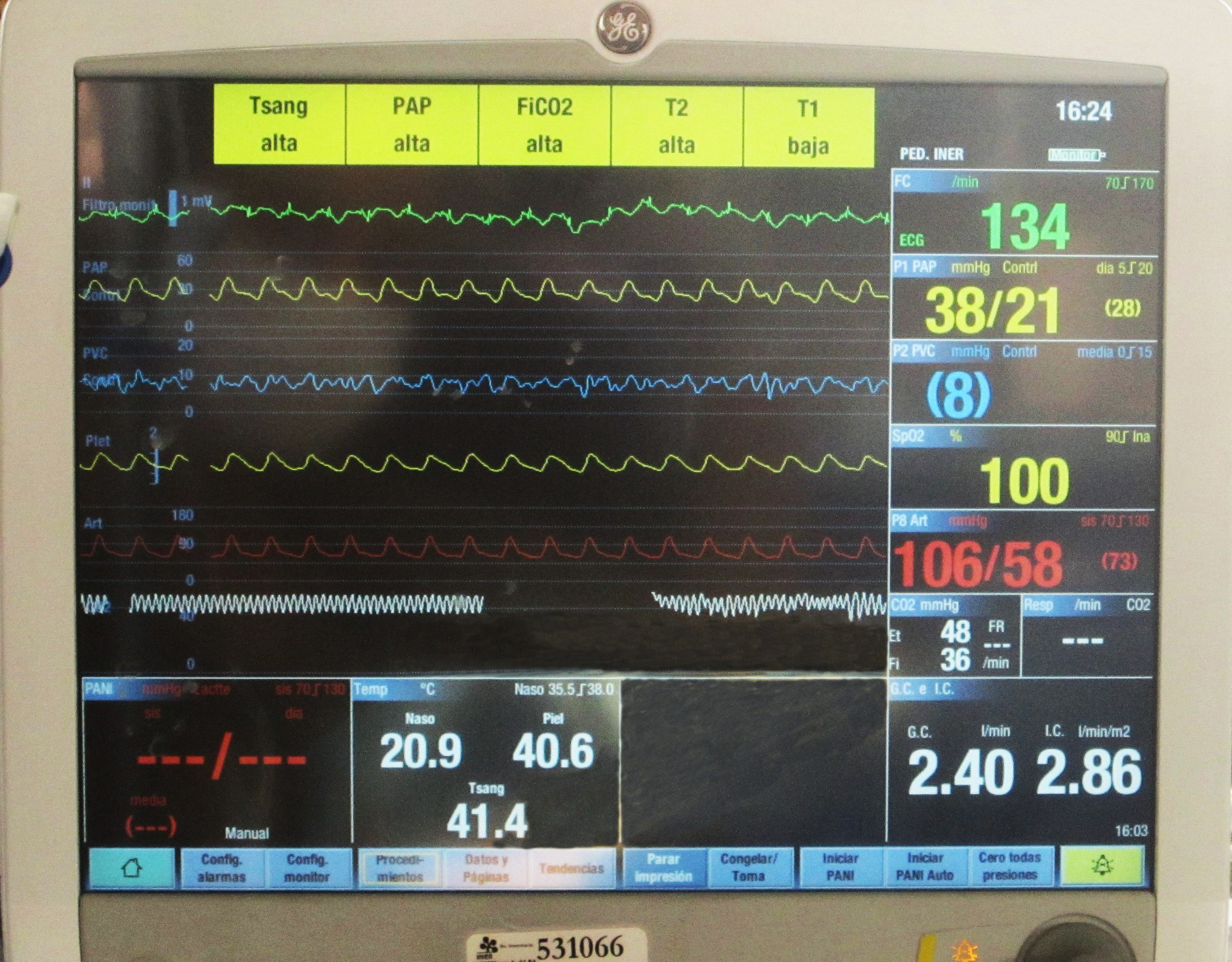 Thermodilution Sensor Determination of Cardiac Output in a Porcine Model for Ex Vivo ...