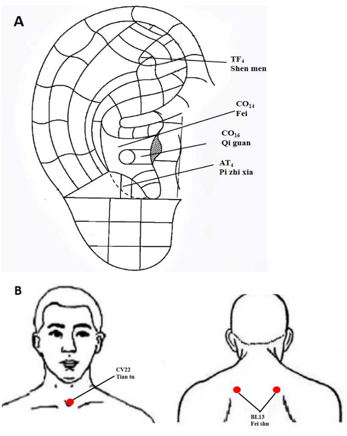 Acupuncture diagram showing ear and body pressure points; therapeutic use in Chinese medicine.