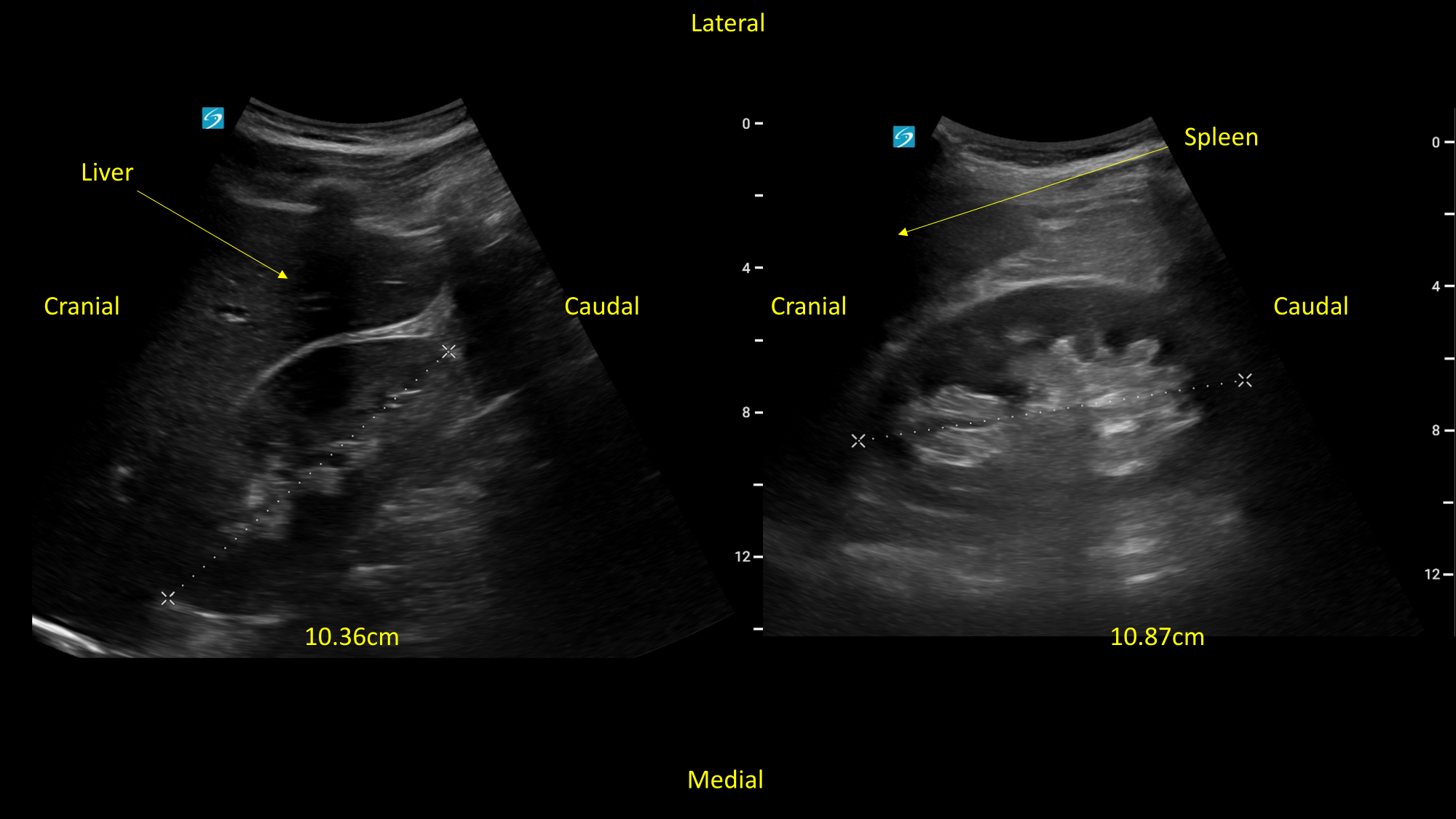 Sigmoid Kidney Ultrasound Sigmoid Kidney Ultrasound