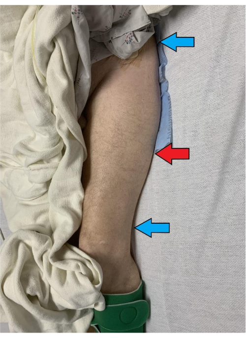 figure-results-1 Leg edema analysis, patient leg with edema signs, arrows indicating swelling in clinical study.