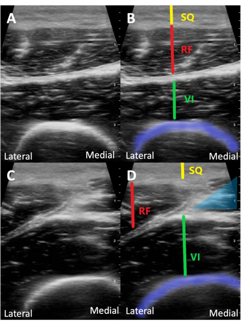 figure-results-3 Ultrasound quadriceps cross-sections, labeled RF, VI, SQ, lateral, medial, muscle layer analysis.